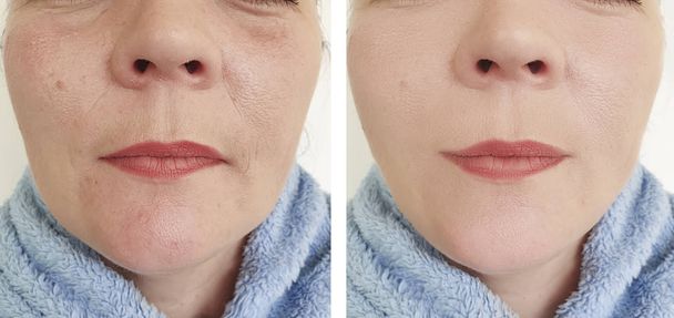 arrugas de la mujer antes y después de procedimientos
 - Foto, imagen
