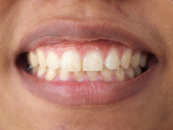 Diastema between the upper incisors is a normal feature - Photo, Image