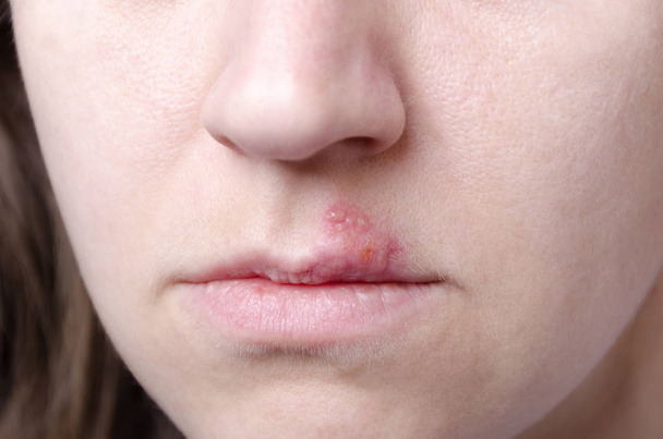 Primer plano del herpes simple en los labios. Primer plano de la cara y los labios de la mujer
 - Foto, Imagen