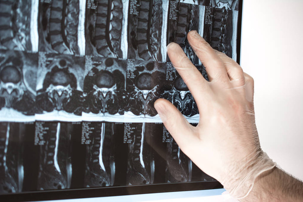 La mano del médico muestra algo en los resultados de la resonancia magnética (resonancia magnética t
 - Foto, imagen