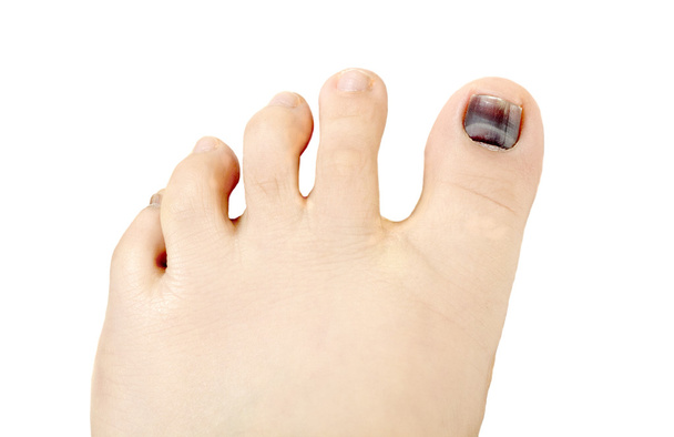 tirnak hematom mavi ve siyah toe nail - Fotoğraf, Görsel