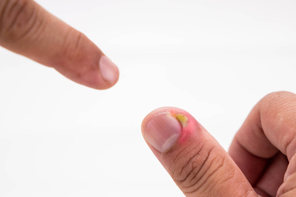 Serie de infección dolorosa de la piel de las uñas con tratamiento de pus
 - Foto, Imagen