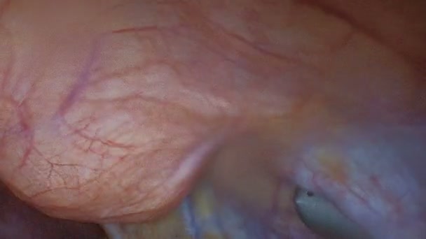 Endovideocirurgia. Laparoscopia. Veja a câmera de vídeo dentro da cavidade abdominal de um paciente doente
. - Filmagem, Vídeo
