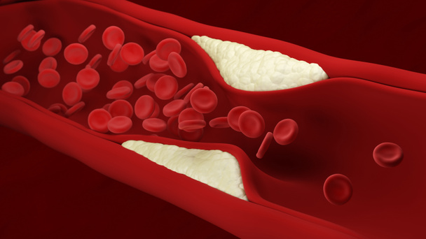 Atherosclerosis. Plaque builds up inside an artery. Blood cells. 3d illustration. - Фото, изображение
