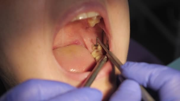 Ο οδοντίατρος εξετάζει τους ασθενείς με δόντι με μαύρη κοιλότητα σε αυτό χρησιμοποιώντας Οδοντιατρικά εργαλεία και καθρέφτη. Τερηδόνα κοντινά πλάνα. - Πλάνα, βίντεο