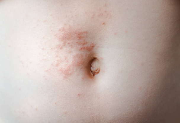 Bebé de varicela. El virus de la varicela zóster o sarna erupción en el niño
. - Foto, Imagen
