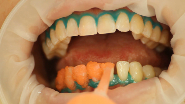 Zahnaufhellung. Anwendung von Zahnweiß-Gel auf die Zähne. Stomatologie - Filmmaterial, Video