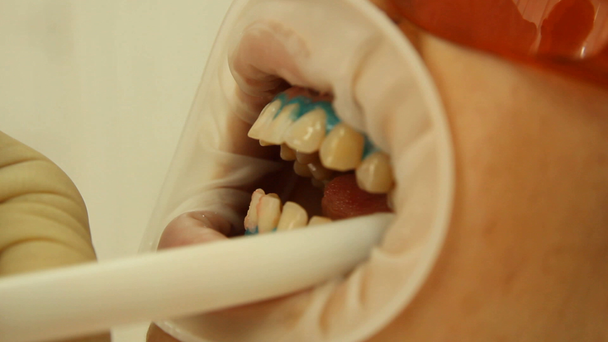 Teeth Whitening. Dental vacuum cleaner. stomatology - Imágenes, Vídeo
