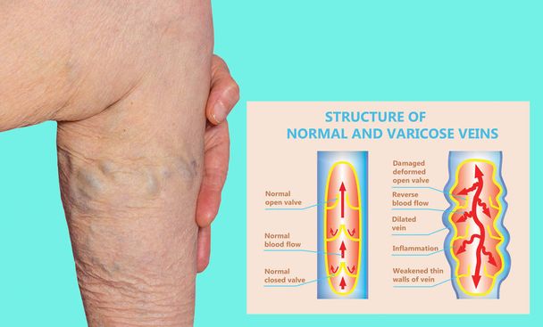 Yaşlı bir kadının bacaklarında varis damarları var. Normal ve varisli damarların yapısı. - Fotoğraf, Görsel