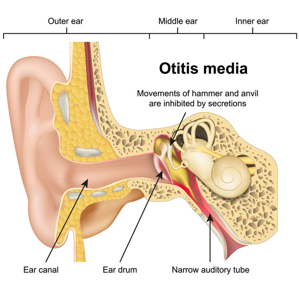 Beyaz arka planda Otitis media kulak hastalığı 3d tıbbi vektör illüstrasyon - Vektör, Görsel