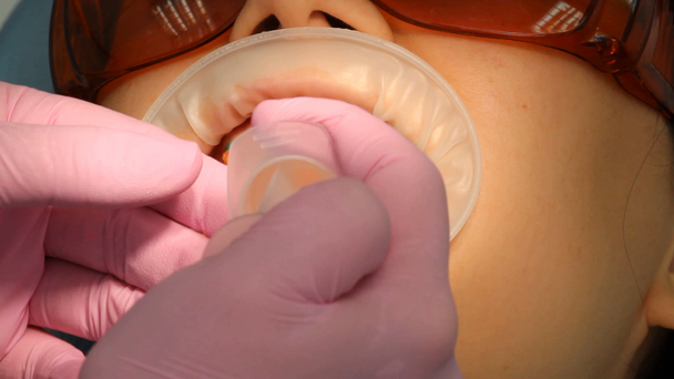 δόντια που λευκαίνουν την οδοντιατρική - Πλάνα, βίντεο