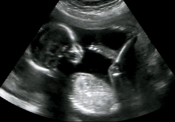 Échographie obstétricale du foetus au quatrième mois
 - Photo, image