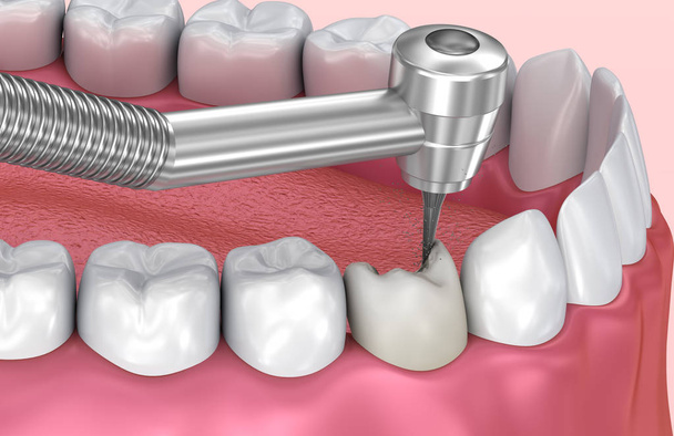 Entfernen der Karies. medizinisch korrekte 3D-Abbildung der Zähne - Foto, Bild