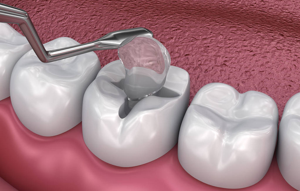Remplissages de fissures dentaires, illustration 3D médicalement précise
 - Photo, image