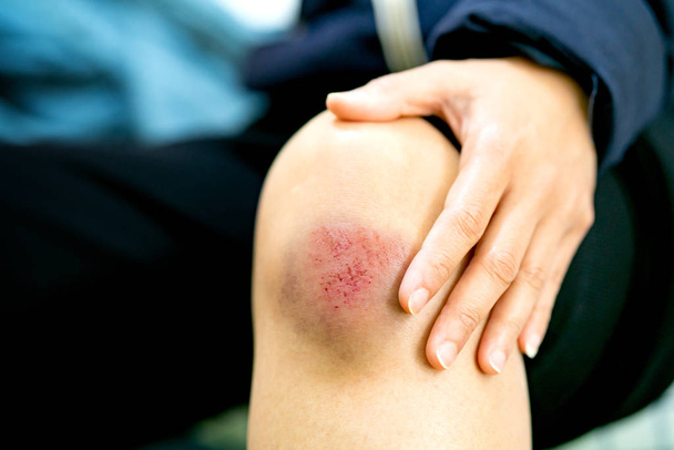 Kratzwunde am Knie einer Frau, Gesundheits- und Medizinkonzept - Foto, Bild