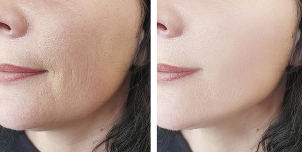 arrugas de la cara de la mujer antes y después de procedimientos de cosmetología
 - Foto, imagen