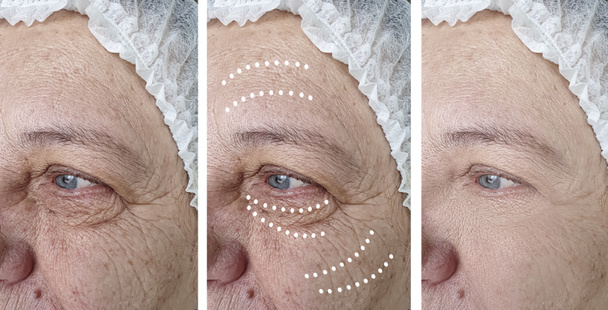 Mujer anciana frente a las arrugas antes y después de los procedimientos de cosmetología
 - Foto, Imagen