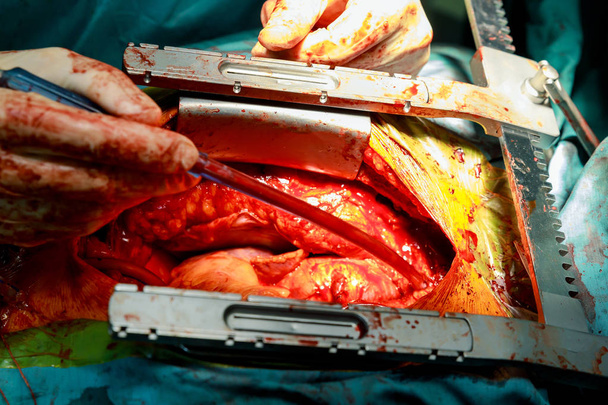 Chirurgie cardiaque. Chirurgie à cœur ouvert suture veine saphène plus grande
 - Photo, image