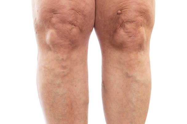 Legs with varicose veins - Photo, Image