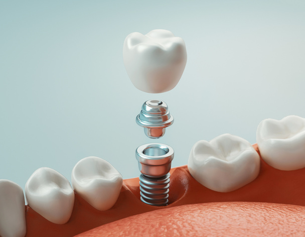 Cuidados dentários, implante dentário, renderização 3d
 - Foto, Imagem