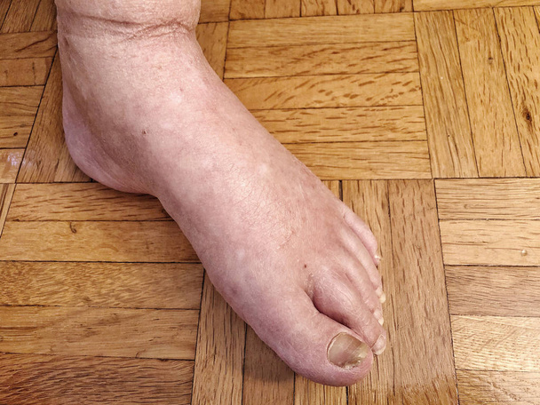 真菌のために損傷した爪を持つ女性の足 - 写真・画像