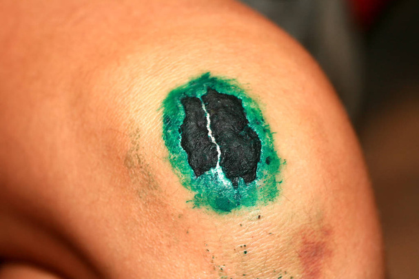 Ferita cicatrizzante al ginocchio. La ferita trattata con verde brillante. La crosta salirà
 - Foto, immagini