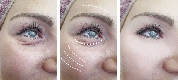 arrugas de la mujer antes y después del tratamiento
 - Foto, Imagen