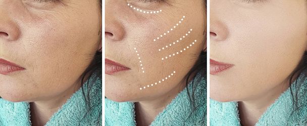 arrugas de la mujer antes y después de procedimientos de collage de regeneración
 - Foto, imagen