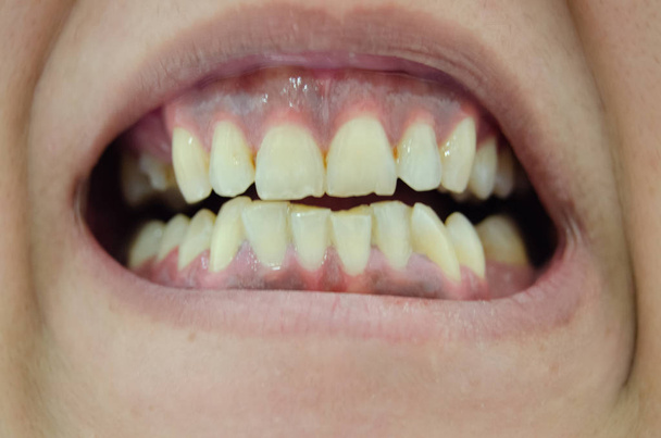 Άτομο που δείχνει πολύ άσχημα σπασμένα και κίτρινα δόντια - Φωτογραφία, εικόνα