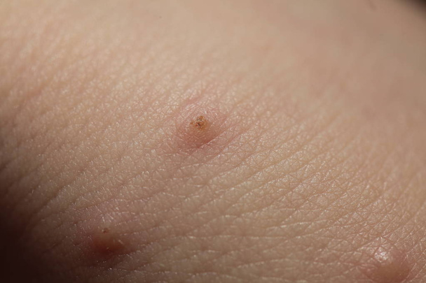insect bites on  skin  child - Photo, Image