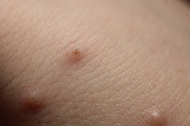 picaduras de insectos en la piel del niño
 - Foto, Imagen