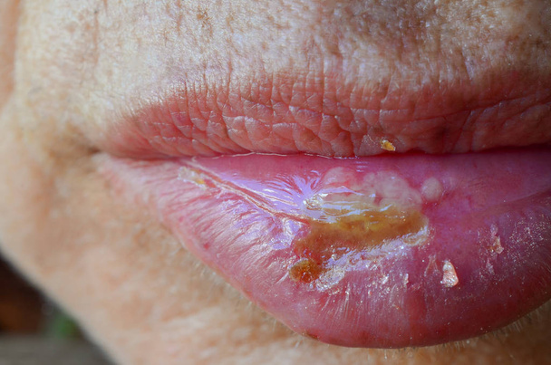 Macro shot di Herpes simplex labialis
 - Foto, immagini