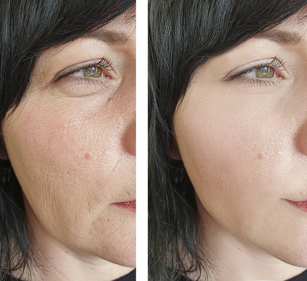 zmarszczki twarzy kobiety przed i po leczeniu kosmetologicznym - Zdjęcie, obraz