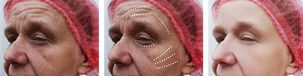  Zmarszczki starszych kobiet twarz przed i po procedurach korekcyjnych - Zdjęcie, obraz