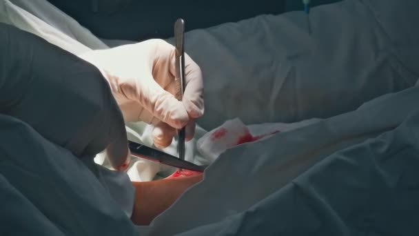 Lekarze w pomieszczeniu chirurgii podczas zabiegu chirurgicznego żyły - Materiał filmowy, wideo