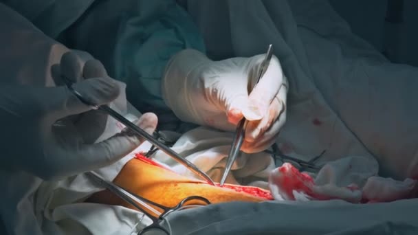 Chirurgia dla operacji pomostowania aortalno-wieńcowego w sali operacyjnej - Materiał filmowy, wideo
