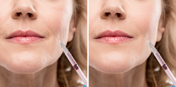 collage de mujer de mediana edad que recibe inyección de belleza antes y después del retoque
 - Foto, Imagen