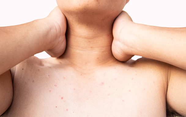 Acne on chest and neck - Photo, Image