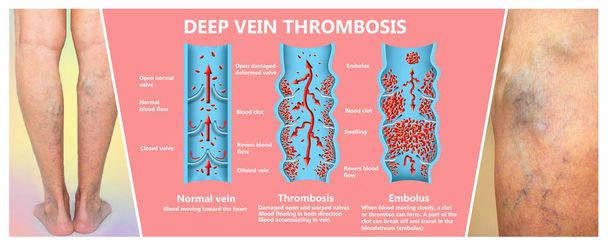 Thrombose veineuse profonde ou caillots sanguins. Embolus
. - Photo, image