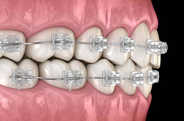 Dientes Tirantes transparentes en encías. Ilustración dental 3D médicamente precisa
 - Foto, imagen