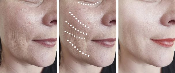 Frauengesichtsfalten vor und nach der Korrektur Collage - Foto, Bild