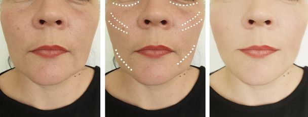 nő arc ráncok előtt és után korrekció kollázs - Fotó, kép