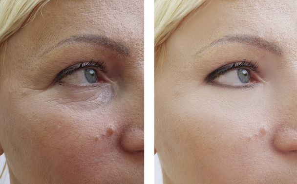 arrugas de la mujer antes y después de los procedimientos de elevación corrección
 - Foto, Imagen