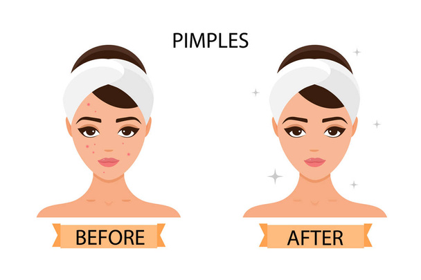 Dziewczyna ma pryszcze na twarzy. Przed i po. Koncepcja pielęgnacji skóry, czysta i zdrowa skóra. Ilustracja wektorowa - Wektor, obraz