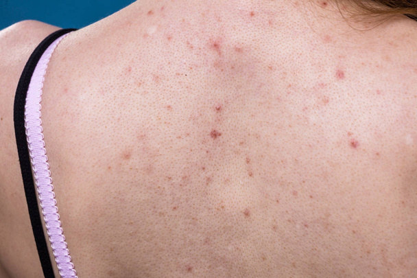 woman with skin problem acne on back - 写真・画像