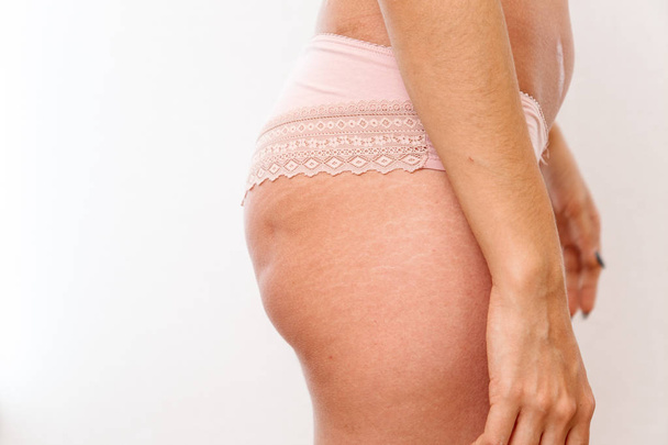 jeune femme montre ses fesses avec de la cellulite et des vergetures
  - Photo, image