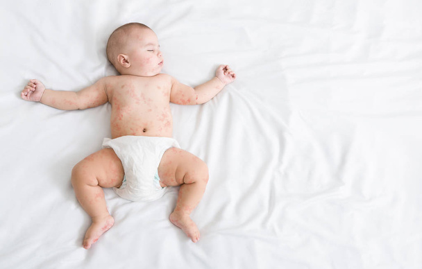 ベッドの上で眠っている麻疹発疹を持つ新生児 - 写真・画像