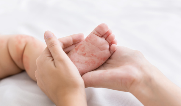 麻疹発疹を持つ小さな赤ちゃんの足を持つ母 - 写真・画像