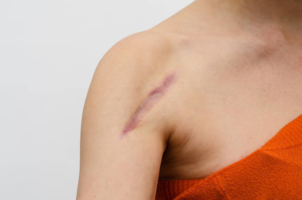 Close-up van de vrouwelijke schouder met een litteken na het installeren van een metalen plaat botbreuk operatief. Helende wonden - Foto, afbeelding