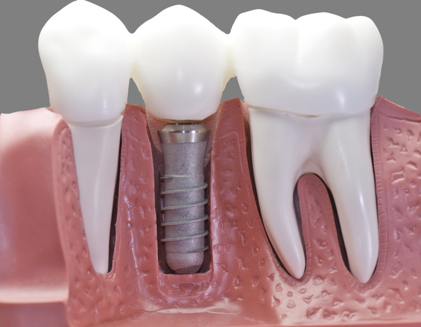 キャップの歯科インプラント モデル - 写真・画像